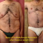 Body Lift Before & After Patient #6041