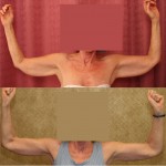 Arm Lift (Brachioplasty) Before & After Patient #6141