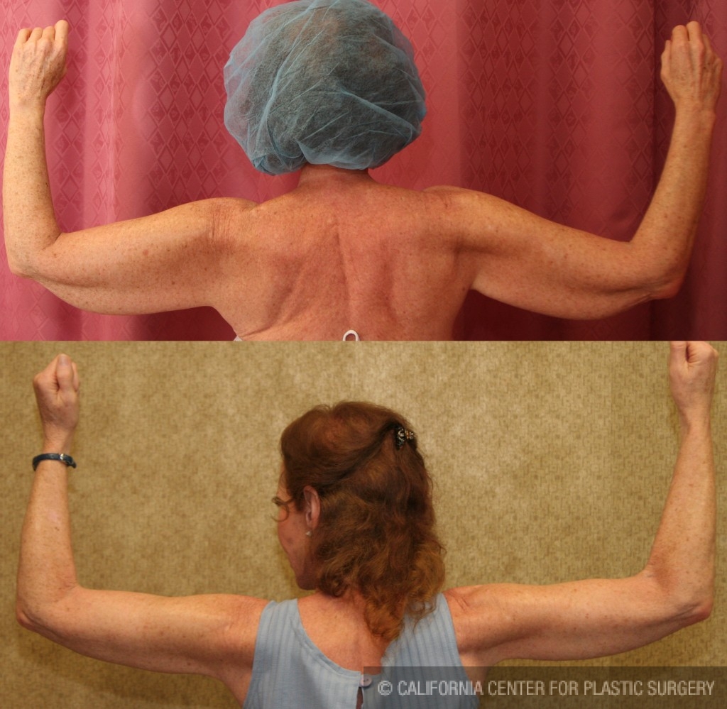 Arm Lift (Brachioplasty) Before & After Patient #6141