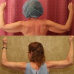 Arm Lift (Brachioplasty) Before & After Patient #6141