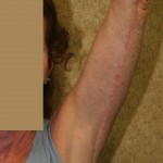 Arm Lift (Brachioplasty) Before & After Patient #6141