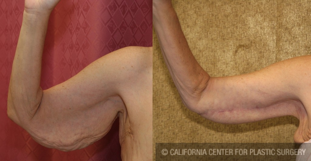 Arm Lift (Brachioplasty) Before & After Patient #6165