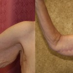 Arm Lift (Brachioplasty) Before & After Patient #6165