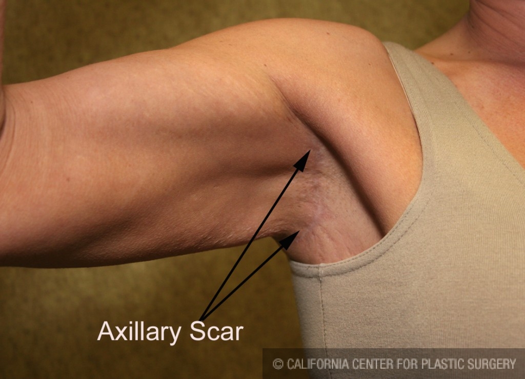 Arm Lift (Brachioplasty) Before & After Patient #6180