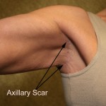 Arm Lift (Brachioplasty) Before & After Patient #6180