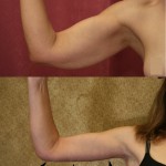 Arm Lift (Brachioplasty) Before & After Patient #6149