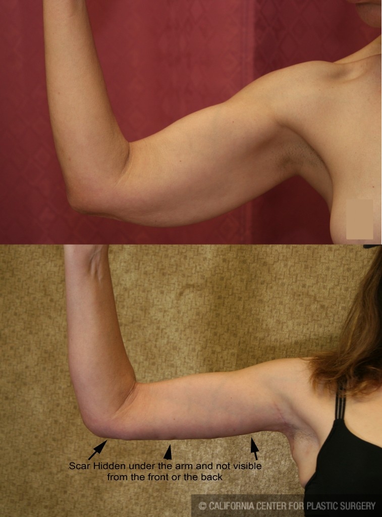 Arm Lift (Brachioplasty) Before & After Patient #6149