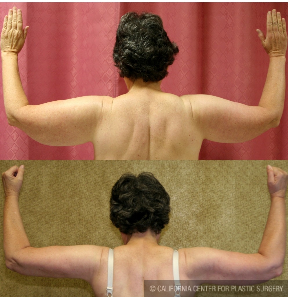 Arm Lift (Brachioplasty) Before & After Patient #6160