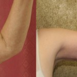 Arm Lift (Brachioplasty) Before & After Patient #6160