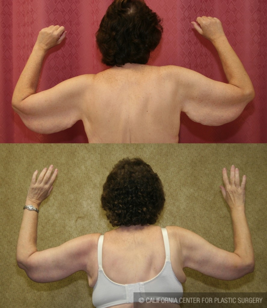 Arm Lift (Brachioplasty) Before & After Patient #6165