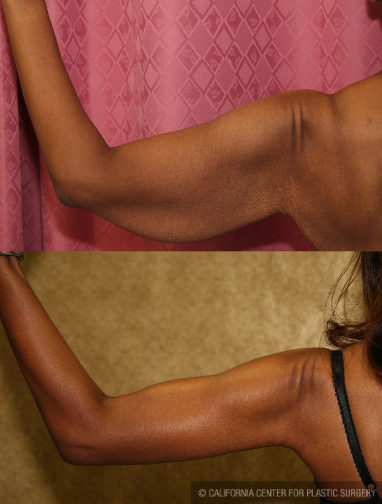Arm Lift (Brachioplasty) Before & After Patient #6125