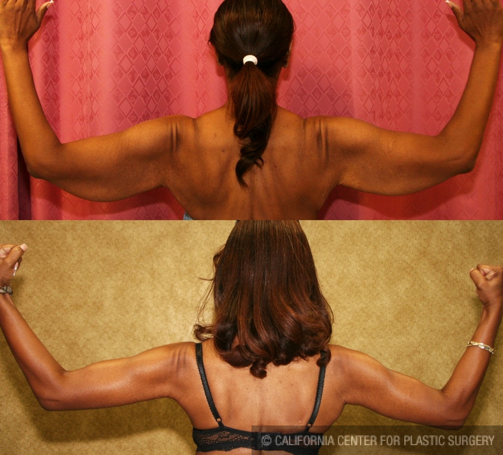 Arm Lift (Brachioplasty) Before & After Patient #6125