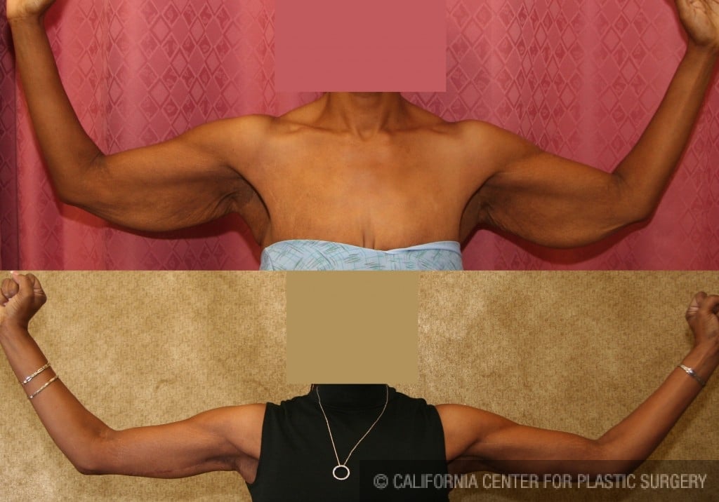 Arm Lift (Brachioplasty) Before & After Patient #6125
