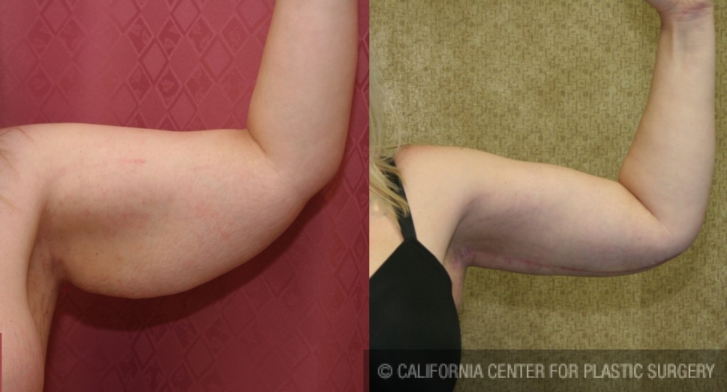 Arm Lift (Brachioplasty) Before & After Patient #6177