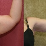 Arm Lift (Brachioplasty) Before & After Patient #6177