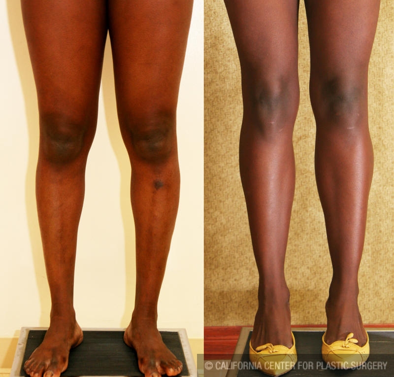 Calf Augmentation Before & After Patient #6869