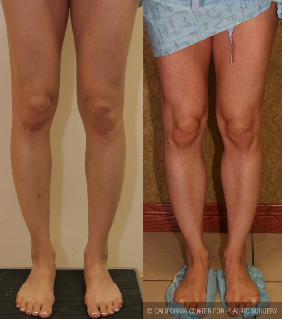 Calf Augmentation Before & After Patient #6879