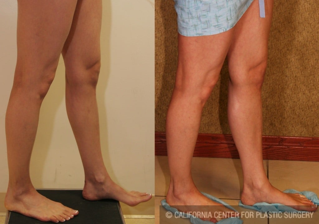 Calf Augmentation Before & After Patient #6879