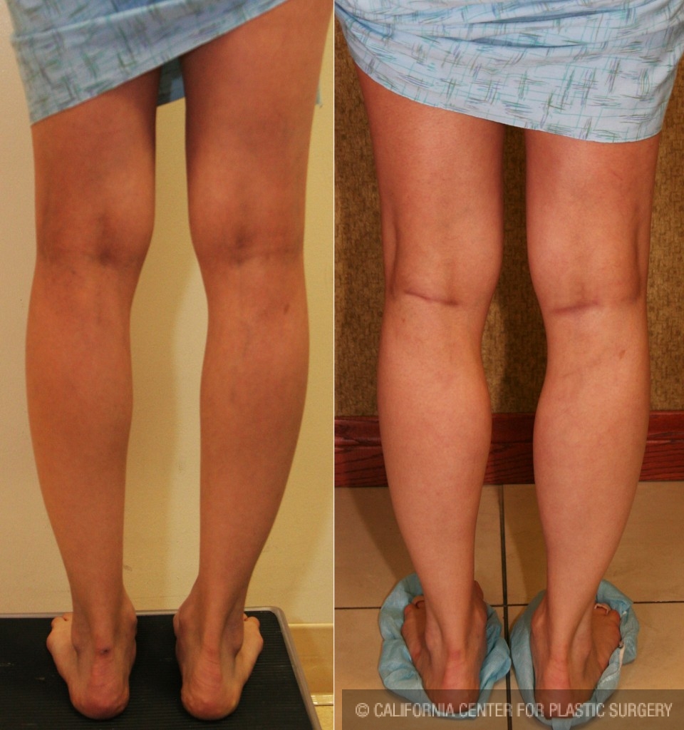 Calf Augmentation Before & After Patient #6879