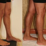 Calf Augmentation Before & After Patient #6874