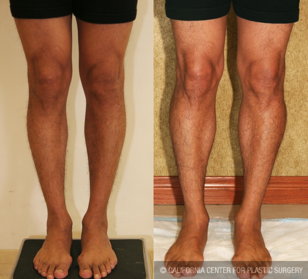 Calf Augmentation Before & After Patient #6874