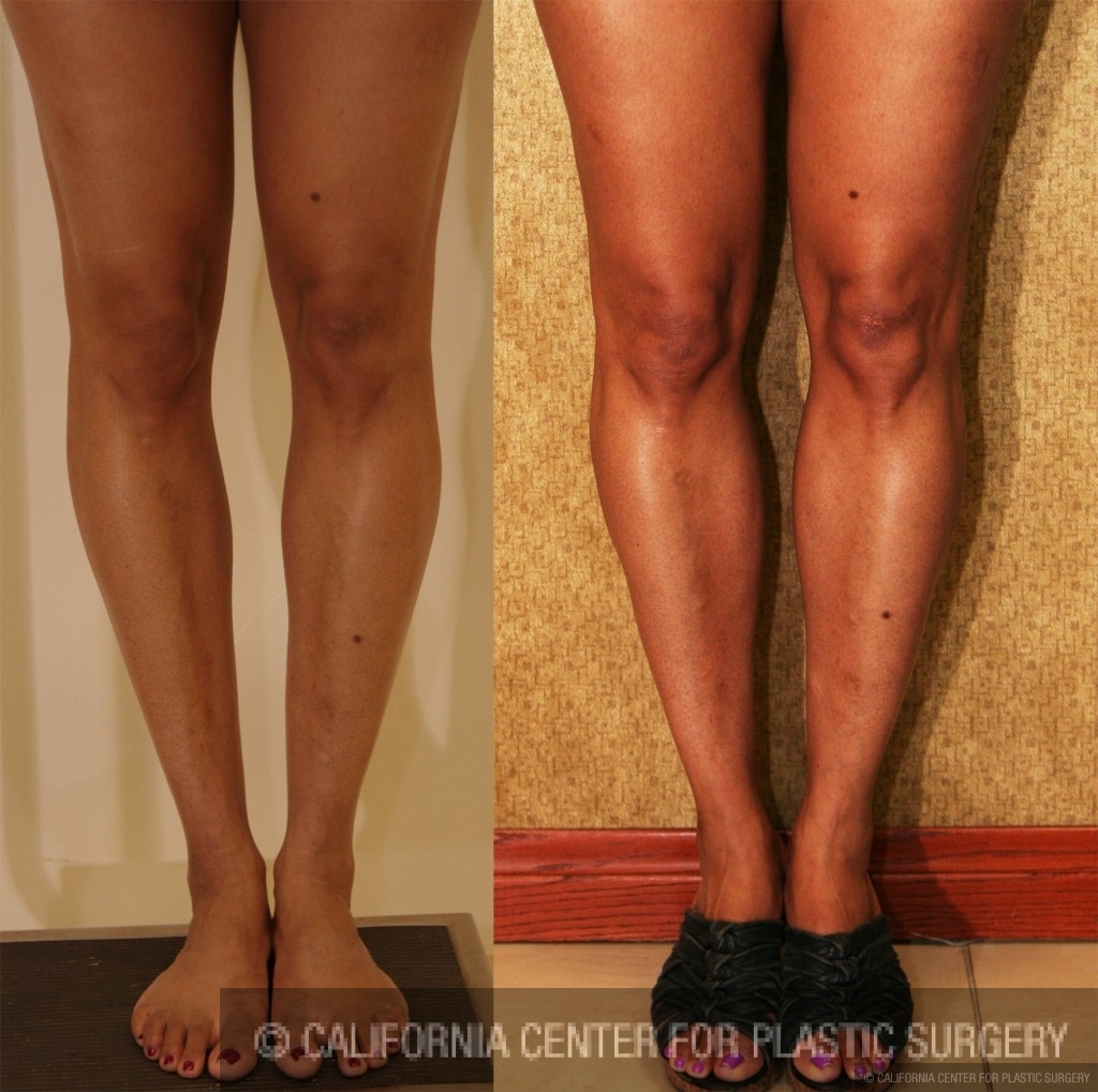 Calf Augmentation Before & After Patient #6892