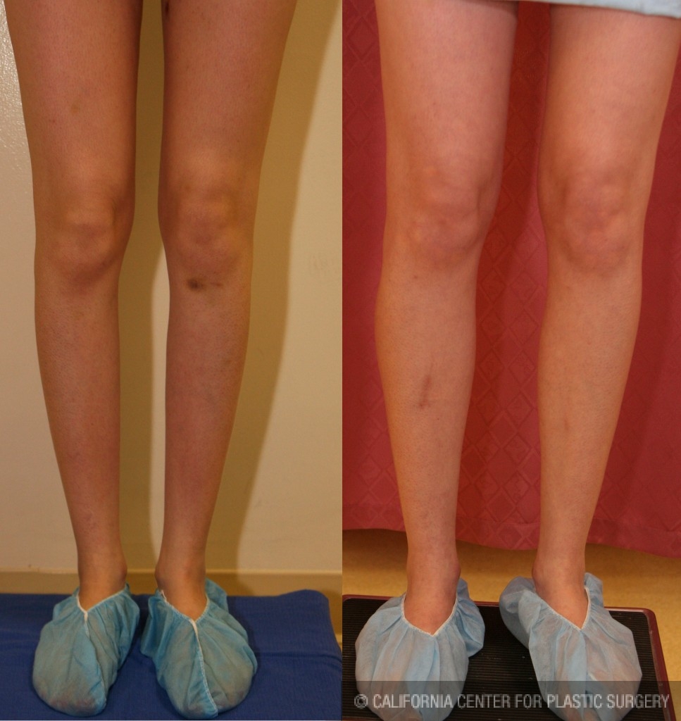 Calf Augmentation Before & After Patient #6887