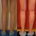 Calf Augmentation Before & After Patient #6887