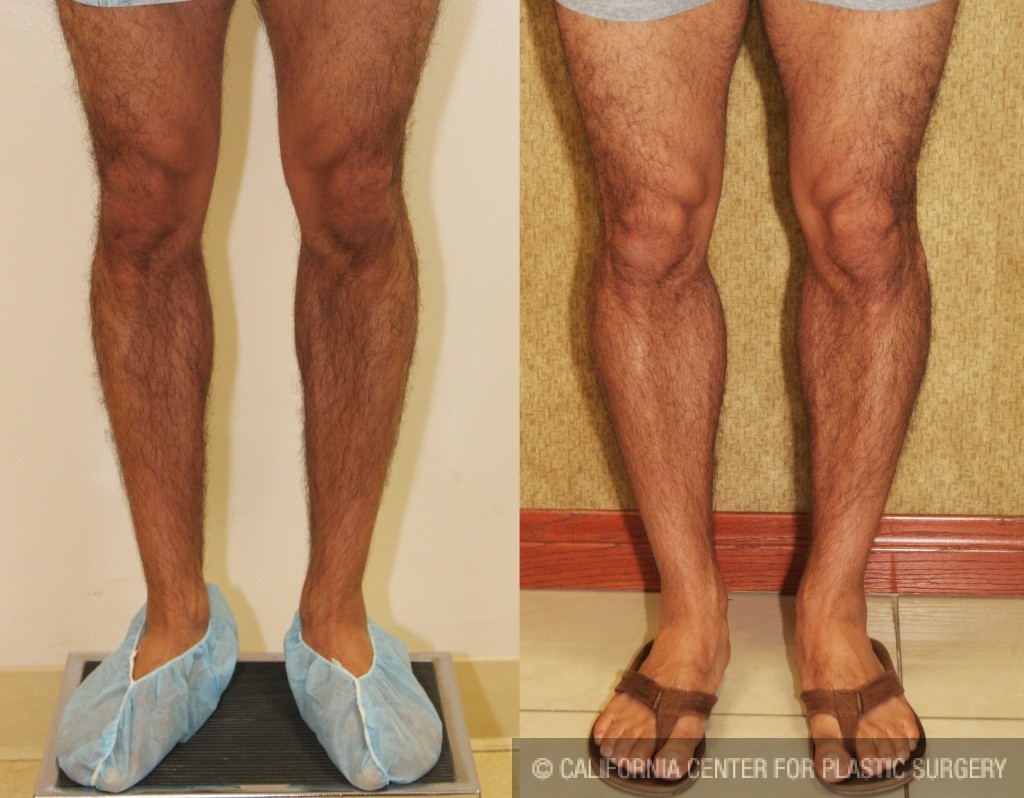 Calf Augmentation Before & After Patient #6883