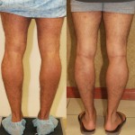 Calf Augmentation Before & After Patient #6883