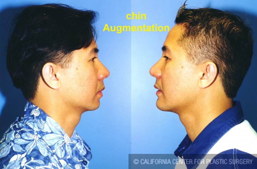 Chin Augmentation Before & After Patient #6799