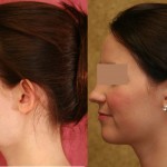 Ear (Otoplasty) Before & After Patient #6439
