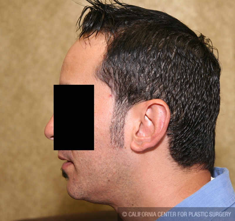 Ear (Otoplasty) Before & After Patient #6451