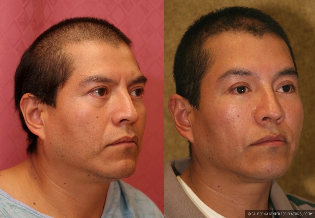 Facial Cosmetic Surgery Before & After Patient #10460