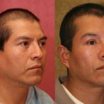 Facial Cosmetic Surgery Before & After Patient #10460