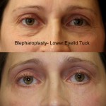 Eyelid (Blepharoplasty) Before & After Patient #6523