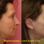 Eyelid (Blepharoplasty) Before & After Patient #6523