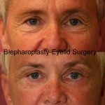 Eyelid (Blepharoplasty) Before & After Patient #6559