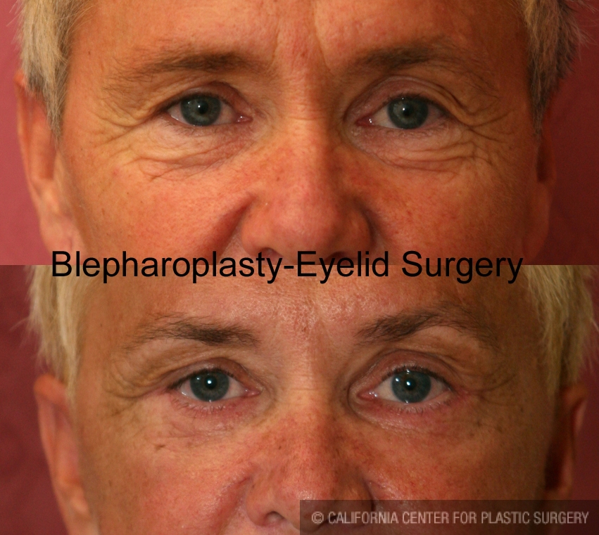 Eyelid (Blepharoplasty) Before & After Patient #6559