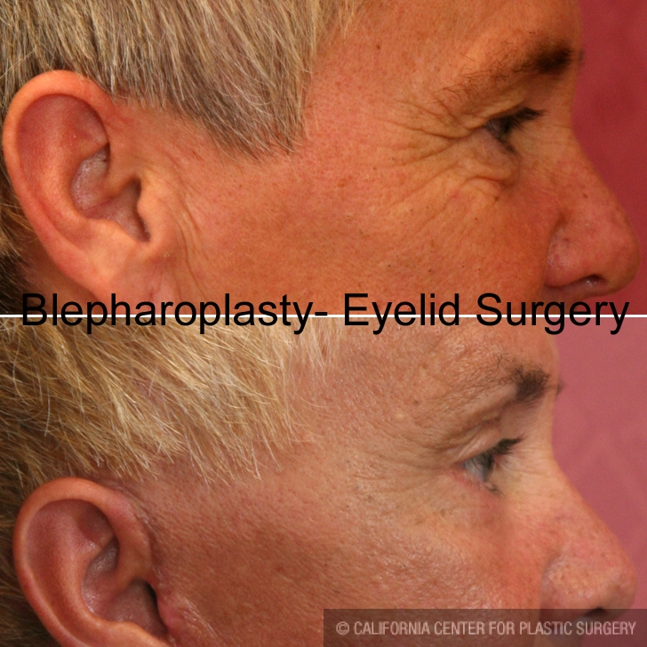 Eyelid (Blepharoplasty) Before & After Patient #6559
