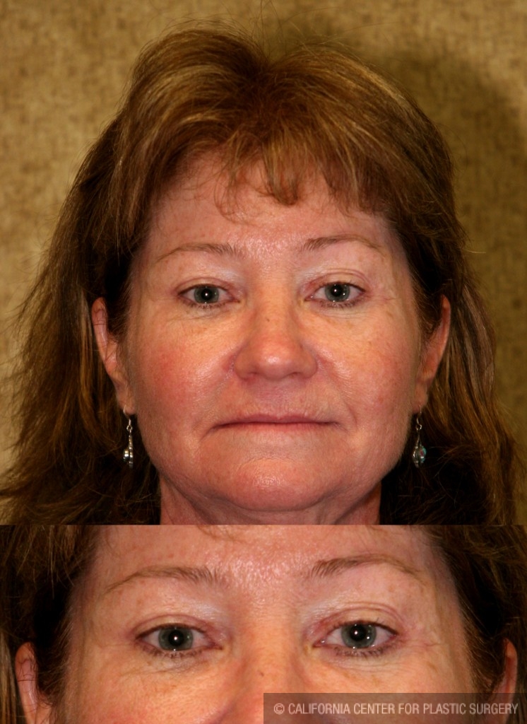 Eyelid (Blepharoplasty) Before & After Patient #6528