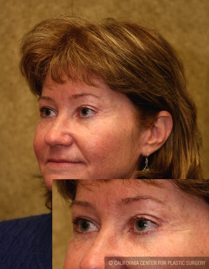 Eyelid (Blepharoplasty) Before & After Patient #6528