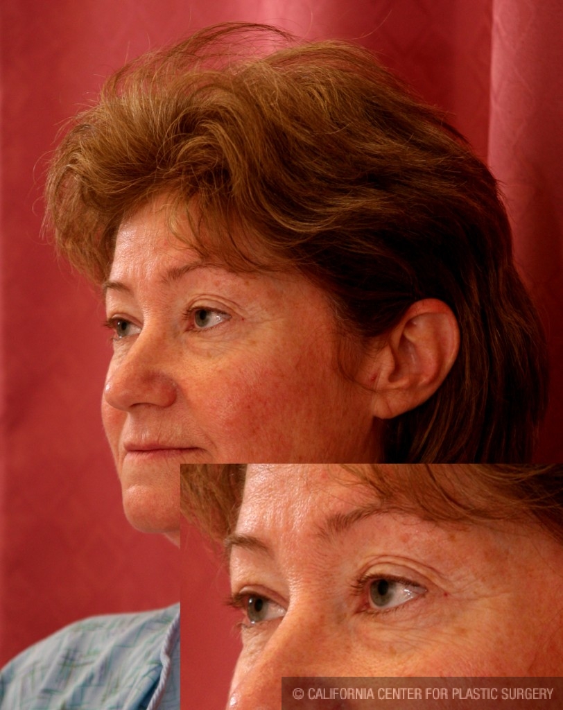 Eyelid (Blepharoplasty) Before & After Patient #6528