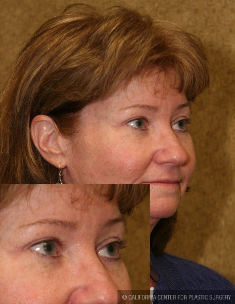 Eyelid (Blepharoplasty) Before & After Patient #6528