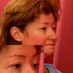 Eyelid (Blepharoplasty) Before & After Patient #6528