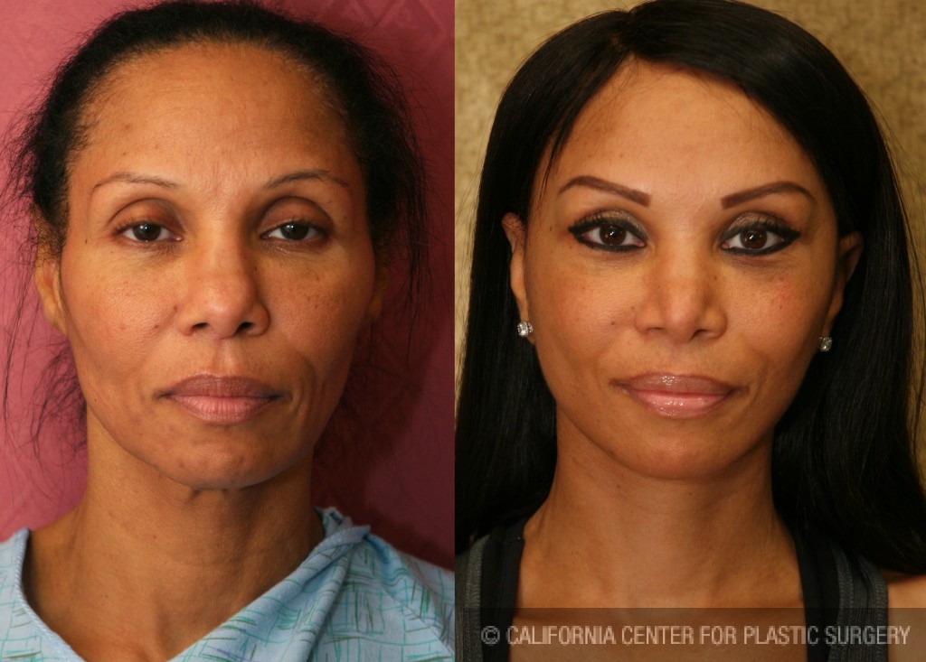 Facelift Before & After Patient #6773