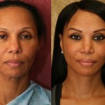 Facelift Before & After Patient #6773