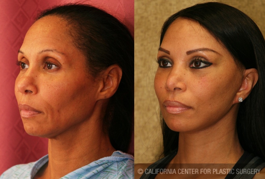Facelift Before & After Patient #6773