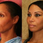 Facelift Before & After Patient #6773