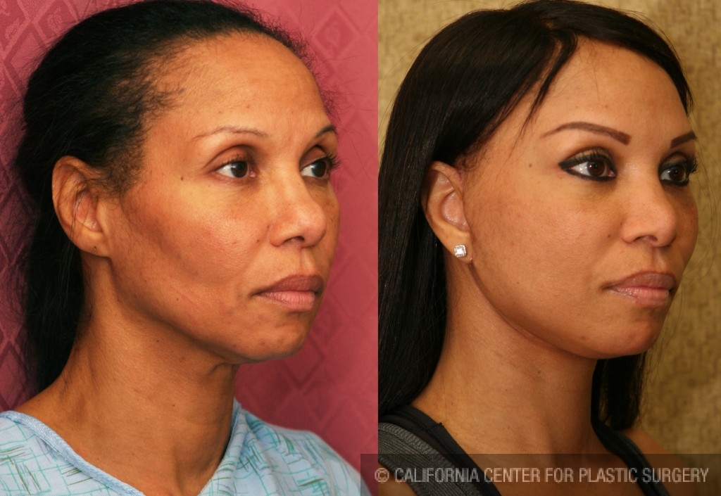 Facelift Before & After Patient #6773